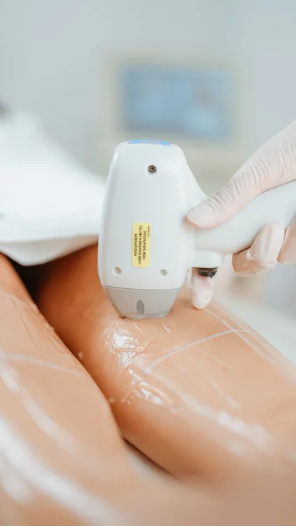 Laser tattoo removal treatment